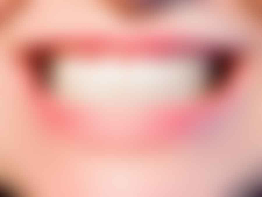 A set of healthy teeth and gums after proper oral self-care
